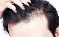 کمبود این ویتامین موجب ریزش موی سکه‌ای می‌شود