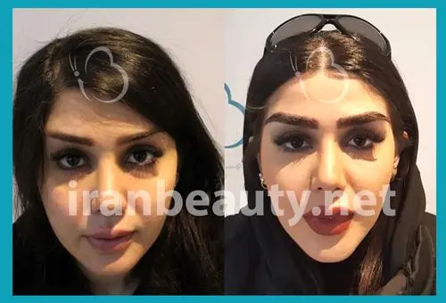 قبل و بعد از کاشت ابرو بدون جراحی