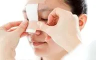 عوارض جراحی بینی را بشناسید