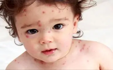 بیماری که در اردیبهشت و خرداد رواج پیدا می کند!