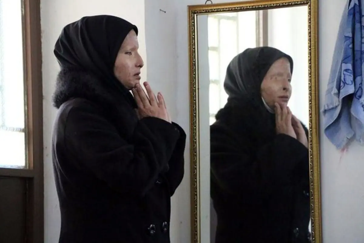زن اسیدپاش دهدشتی به قصاص و دیه محکوم شد + تصاویر