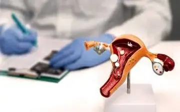 این مشاغل خطرات به ابتلا به سرطان تخمدان را افزایش می‌دهد