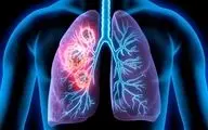 روش‌های موثر برای کاهش خطر ابتلا به سرطان ریه