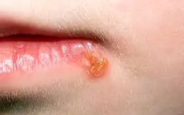 درمان تبخال لب در خانه با ۶ ماده طبیعی