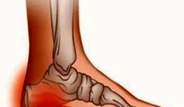 علل سوزش کف پا چیست؟