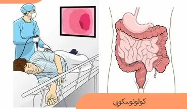  کولونوسکوپی را چند سال یکبار انجام دهیم؟| به سادگی از سرطان پیشگیری کن!