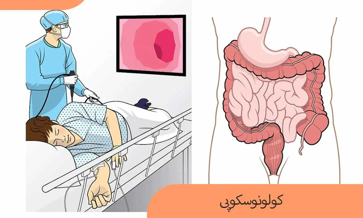  کولونوسکوپی را چند سال یکبار انجام دهیم؟| به سادگی از سرطان پیشگیری کن!