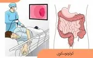  کولونوسکوپی را چند سال یکبار انجام دهیم؟| به سادگی از سرطان پیشگیری کن!