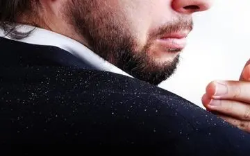 راه‌حل های ساده برای درمان خانگی شوره سر