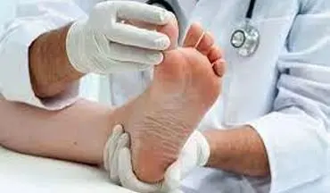 راه های درمان میخچه پا در طب ایرانی