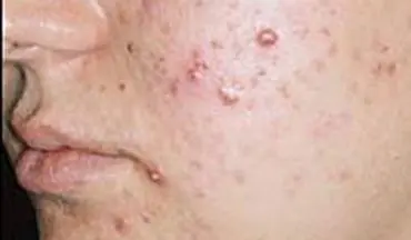 فرمول پاکسازی پوست از لکه ها 
