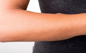 
"پوست مرغی" چیست؟
