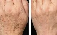 از بین بردن لکه های قهوه ای روی پوست با درمان خانگی
