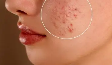 پوست چرب دارید؟ این ۸ باور غلط را دور بریزید