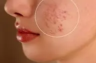 پوست چرب دارید؟ این ۸ باور غلط را دور بریزید