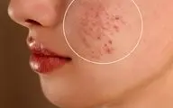 پوست چرب دارید؟ این ۸ باور غلط را دور بریزید