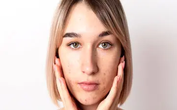 بگو کجای صورتت جوش میزنه تا دلیلش رو بگم