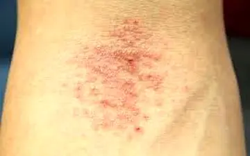 نور آفتاب، علایم اگزما را کاهش می دهد 