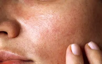 آیا استفاده از ژل شستشو در درمان جوش صورت موثر است؟