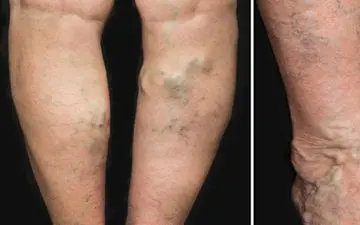 علائم واریس