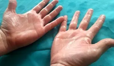 با تعریق کف دست چه کنیم؟ | چند درمان برای تعریق کف دست